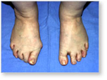 http://www.mdmercy.com/footandankle/conditions/bigtoe/images/valgus_bunion_15.jpg