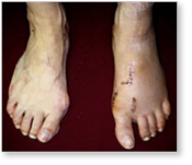 http://www.mdmercy.com/footandankle/conditions/bigtoe/images/valgus_bunion_18.jpg